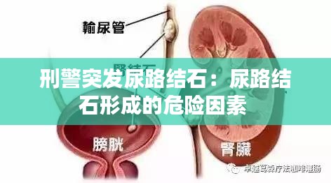 刑警突发尿路结石：尿路结石形成的危险因素 