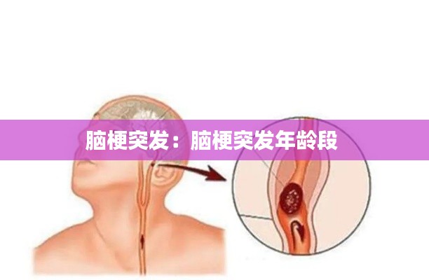 脑梗突发：脑梗突发年龄段 